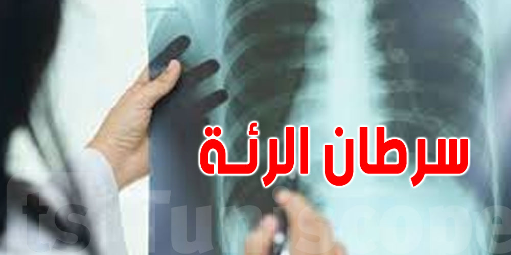 لماذا يصاب الشباب وغير المدخنين بسرطان الرئة؟